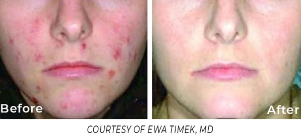 Spectrum Acne Treatment Spectrum Acne Treatment