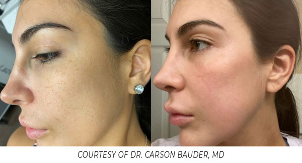 Spectrum Erbium Bauder Spectrum Erbium Bauder